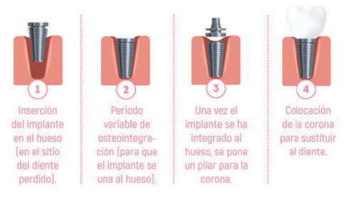 implante